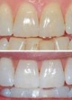 Blanqueamiento Dental