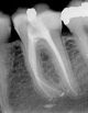 Endodoncia